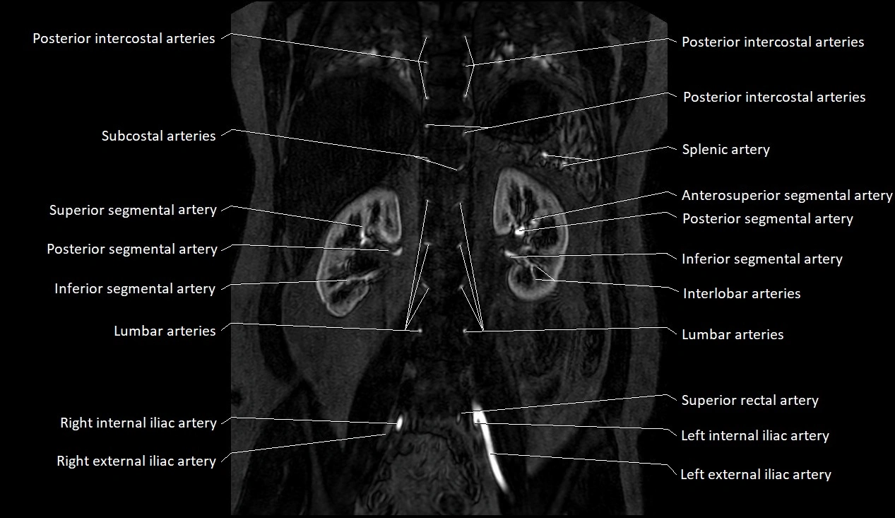 MRA Abdomen coronal anatomy image 32.webp